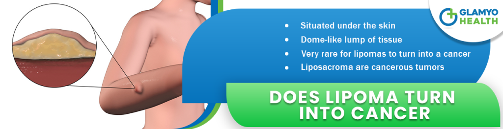 Does lipoma turn into cancer