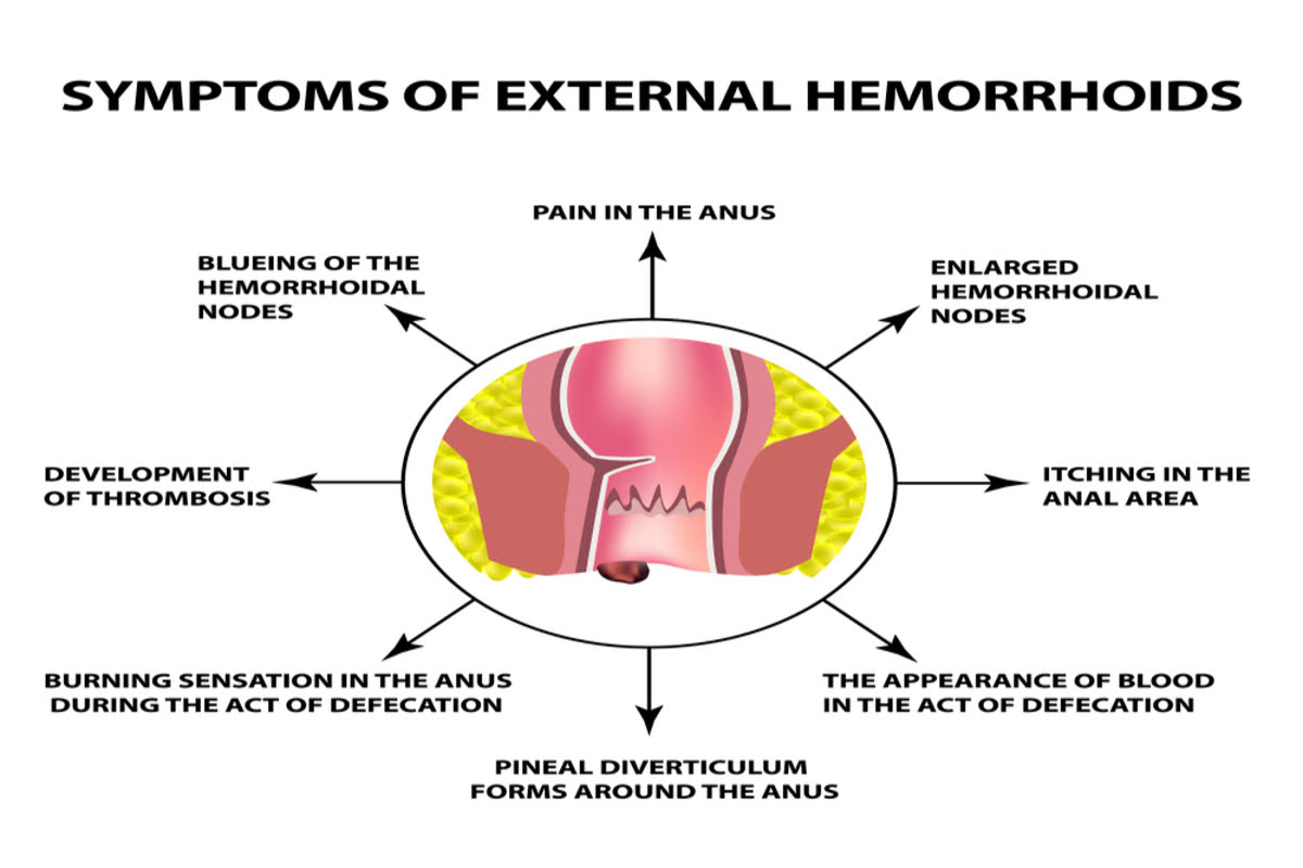 Symptoms-of-External-Hemorrhoids