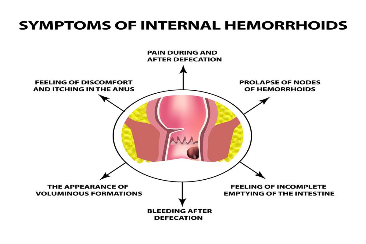 Symptoms-of-Internal-Hemorrhoids