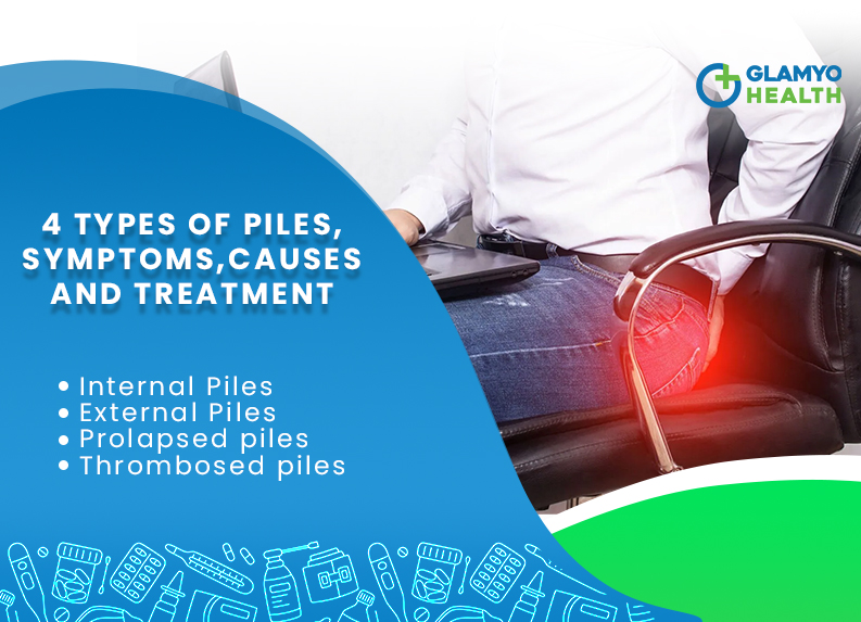 Piles - Symptoms, Meaning, Images, Causes and Types
