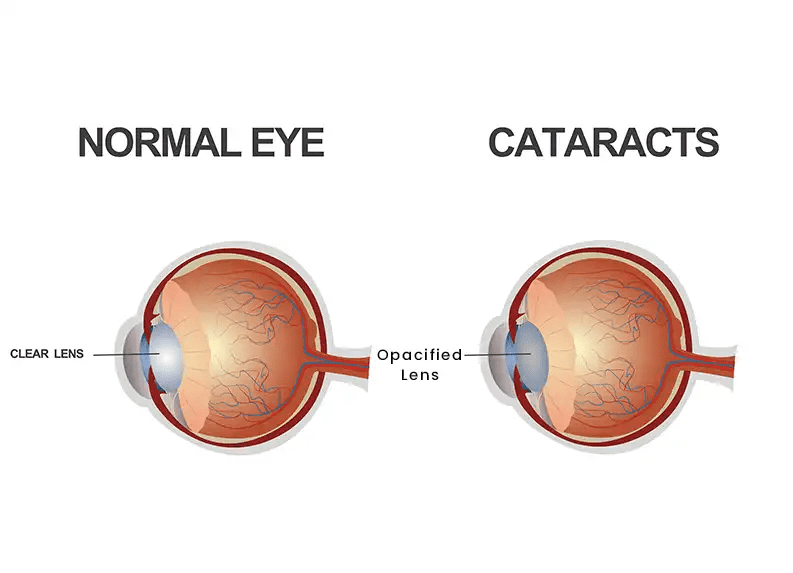 Normal Eye vs Cataracts