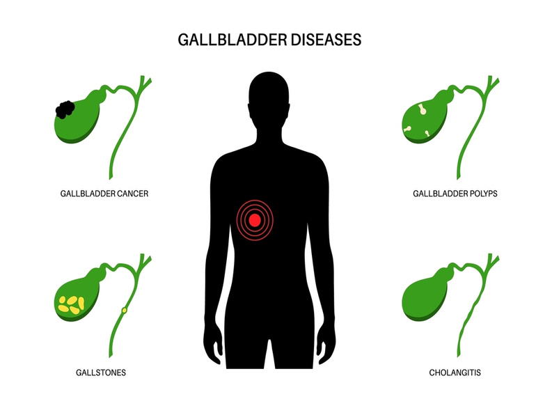 Gallbladder diseases 