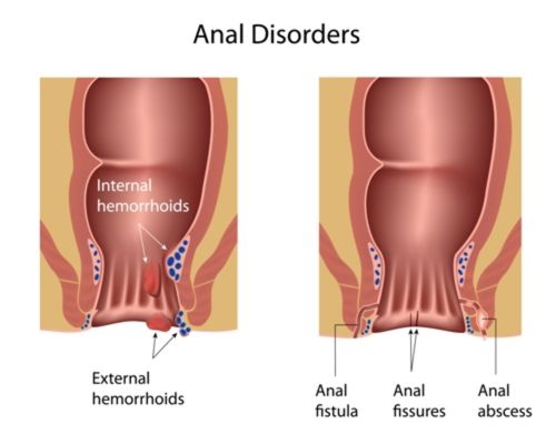 Anal Disorders