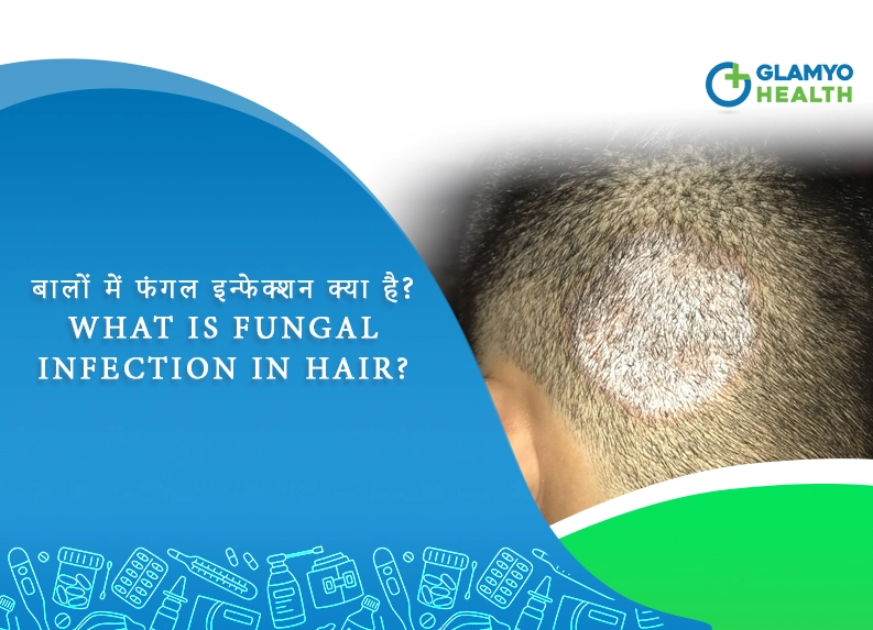 What is Fungal Infection in Hair in Hindi?