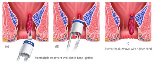 Hemorrhoid ligation with elastic band image
