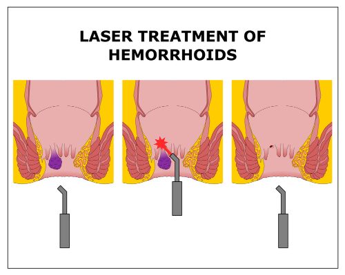Laser treatment of hemorroifd (piles) image