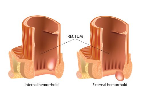 Medical-illustration-showing-internal-and-external-hemorrhoids