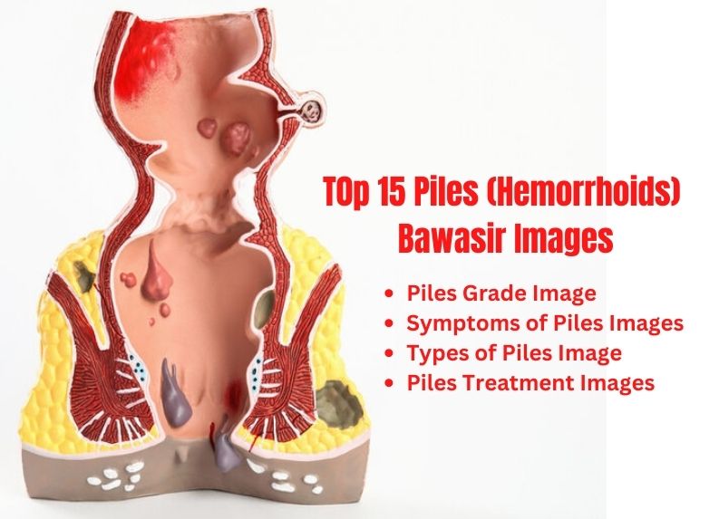 Piles Hemorrhoids Images  Symptoms  Grades and Treatment