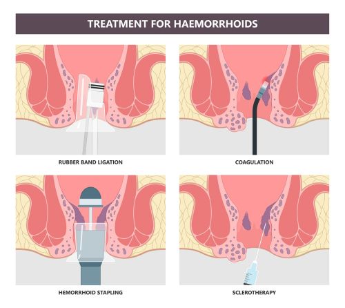 Treatment for haemorroids image