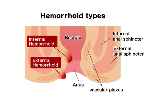 Types of hemorroids image