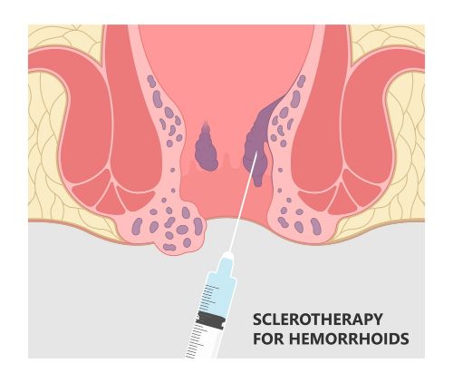 sclerotherapy for hemorroids 