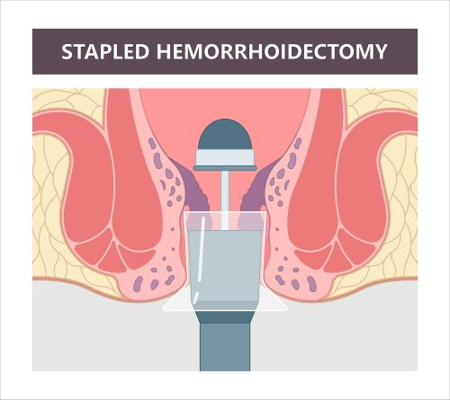 stamorrhoidectomy