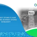 Kidney Stone X-Ray Before Kidney Stone Surgery?