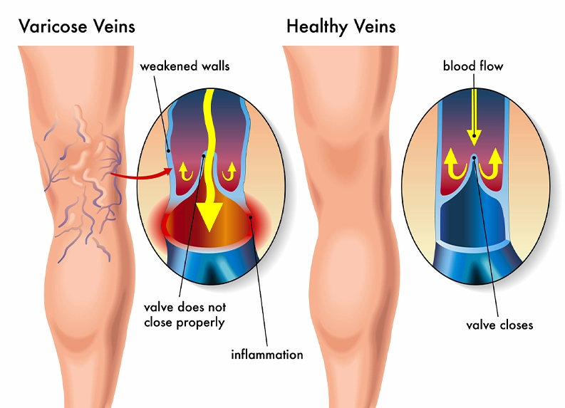 Causes of Spidervaricose veins