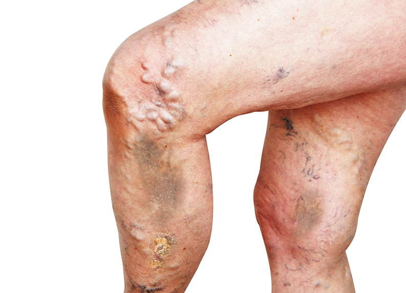 Complications of Spidervaricose vein