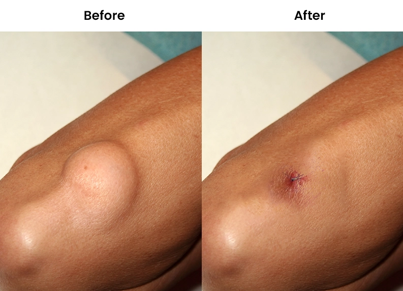 Lipoma removal pictures (Before & After)