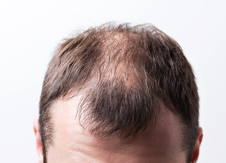Male Pattern Baldness  Treatment and Prevention Guide