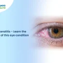Photokeratitis – Learn the Basics of this Eye Condition