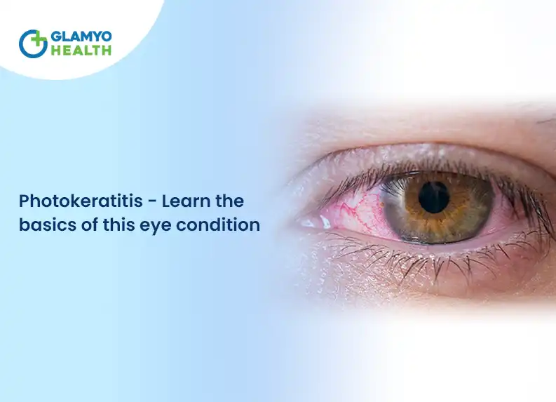 Photokeratitis &#8211; Learn the Basics of this Eye Condition